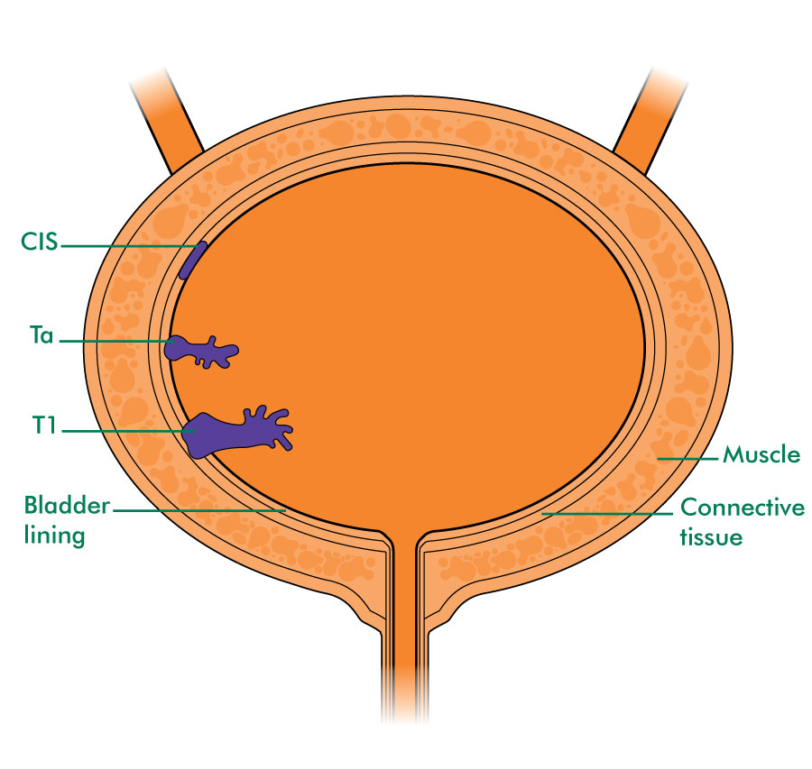 Cancer Of The Bladder Beaumont Hospital